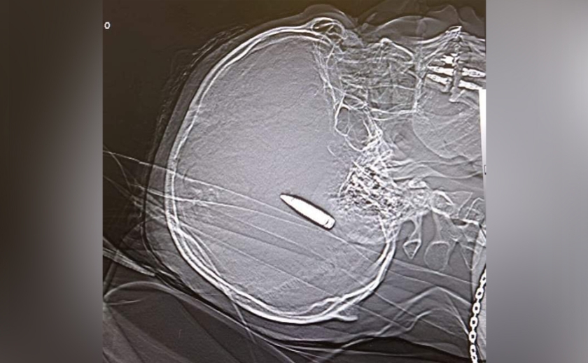 У Дніпрі рятують 35-річного чоловіка, у якого посеред мозку застрягла куля