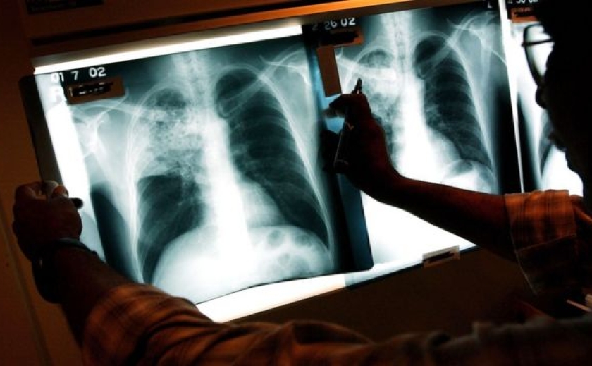 Дніпропетровщина бʼє на сполох: кількість хворих на туберкульоз найвища в України