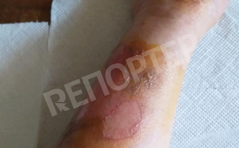 В Днепре маршрутка едва не лишила руки женщину
